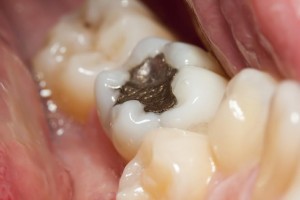 Cavity and Dental Hygiene