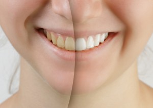 Teeth-whitening