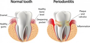 Periodontal disease