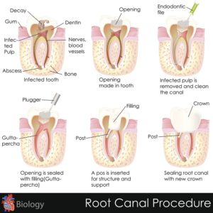 Root Canal Procedure Catonsville Dental Care