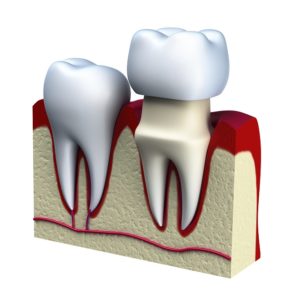 dental crowns Catonsville Dental Care