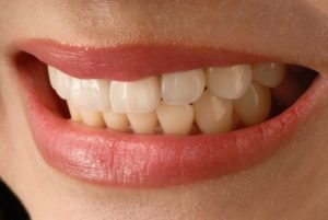 Porcelain Veneers Catonsville Dental Care