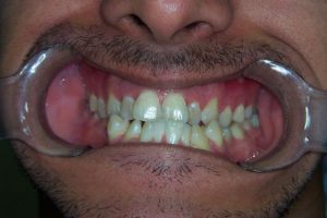 Teeth Whitening in Baltimore County