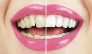 Teeth Whitening Services Catonsville Dental Care