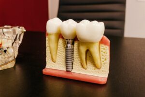 Columbia's Best Dentists for Dental Implants