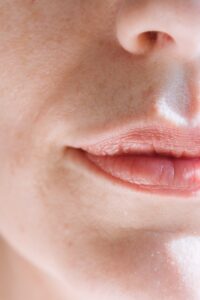 Lip Flips in Baltimore County: 3 Facts Catonsville Dental Care