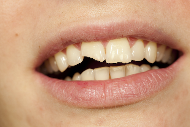 When Is a Chipped Tooth Considered an Emergency?