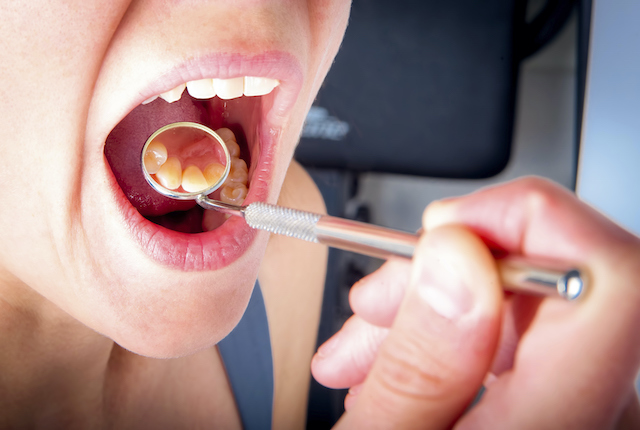 Signs That You Might Have Gum Disease