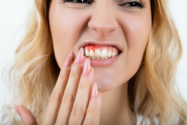 Gum Disease Myths Debunked