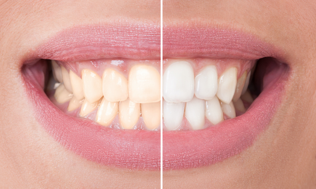 Everything to Know About Tooth Stains