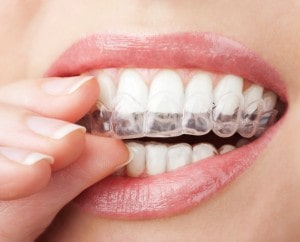 Find Your Smile With Invisalign in Pikesville