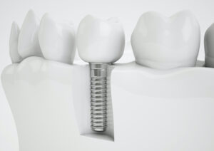 4 Interesting Dental Implant Facts
