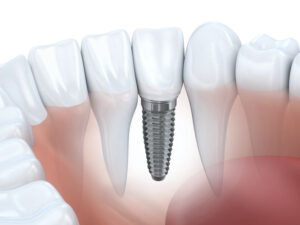 What to Know About Dental Implants