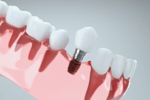 How to Find the Perfect Dental Implant Specialist