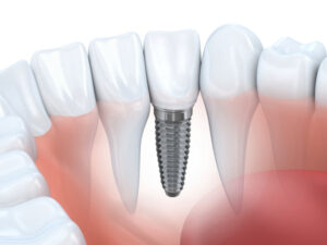 catonsville dental care Dental Implants in Ellicott City catonsville dental care Dental Implants in Ellicott City